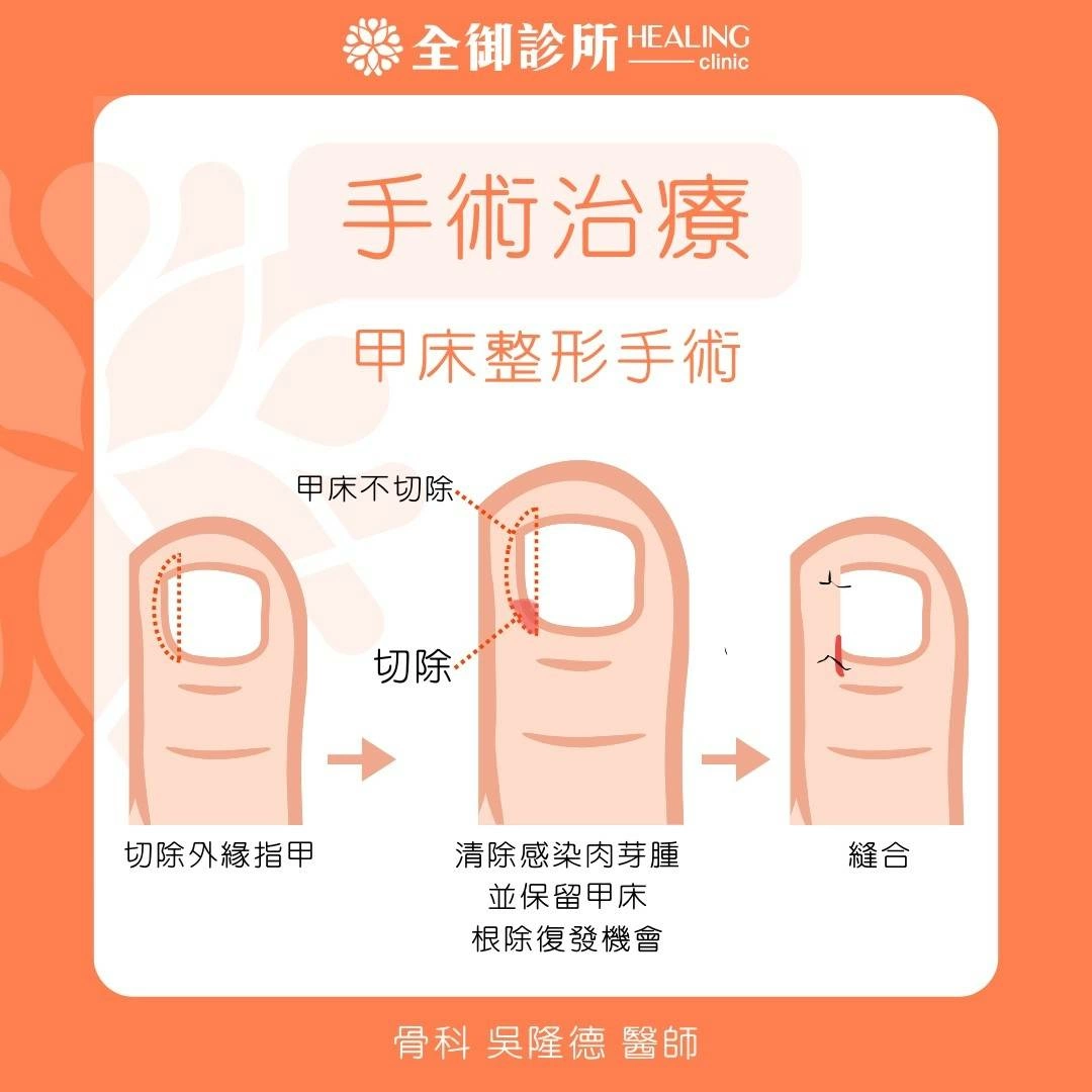 惱人的甲溝炎!甲溝炎的致病原因 惱人的甲溝炎!甲溝炎的致病原因