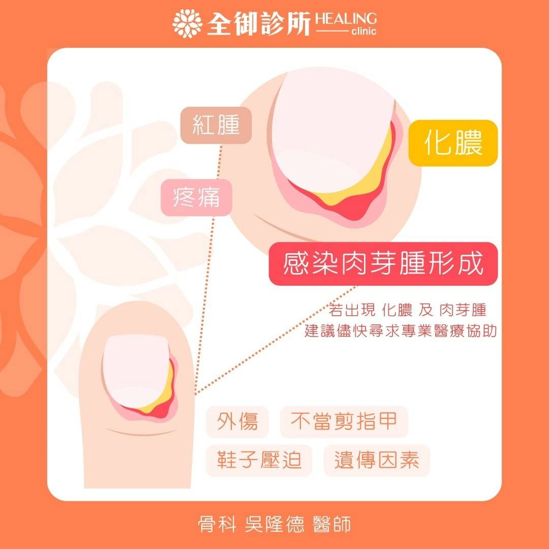 惱人的甲溝炎!甲溝炎的致病原因 惱人的甲溝炎!甲溝炎的致病原因
